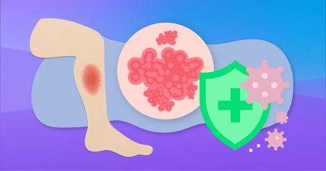 L Rib Cage Rash Lupus Rib and Chest Pain: Costochondritis and 4 Other Causes | MyLupusTeam