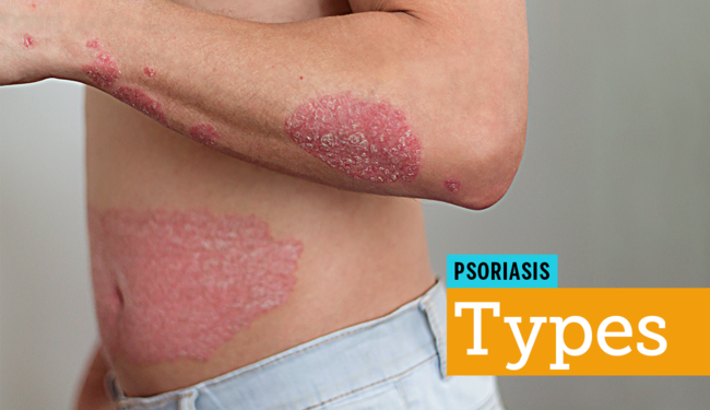 Exfoliative Dermatitis On Scrotum Exfoliative Dermatitis On Scrotum