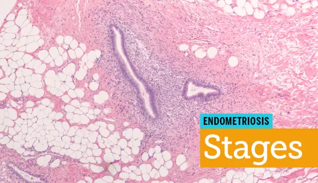 Stages of Endometriosis | MyEndometriosisTeam