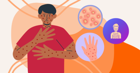 Crohn’s Disease Remission: 5 Types To Know | MyCrohnsAndColitisTeam