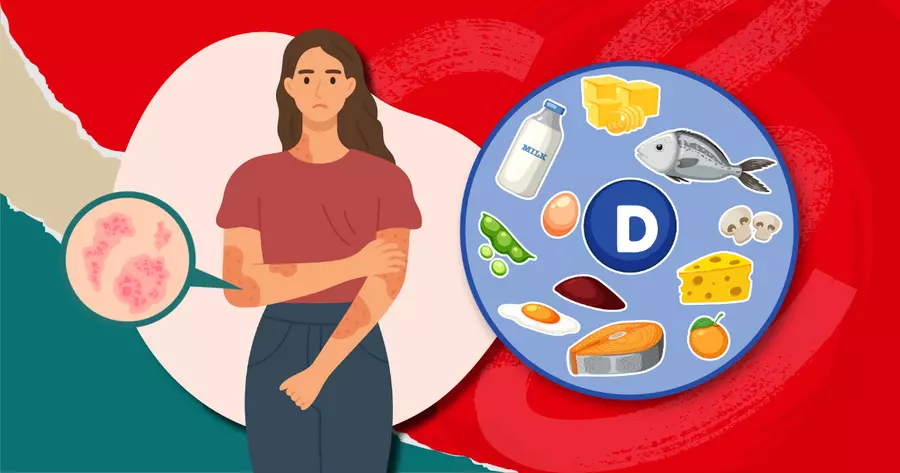 Vitamin D and Eczema: Is There a Link?