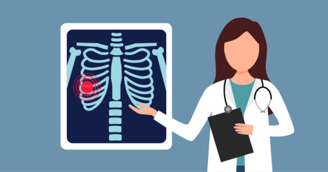 Spondylitis Ribs Psoriatic Arthritis vs. Ankylosing Spondylitis: Connections and ...