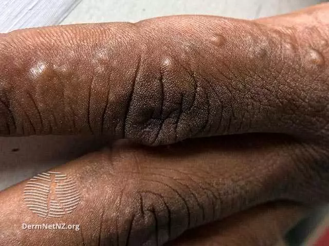 3 Reasons Not To Pop Dyshidrotic Eczema Blisters MyEczemaTeam 3 Reasons Not To Pop Dyshidrotic Eczema Blisters MyEczemaTeam
