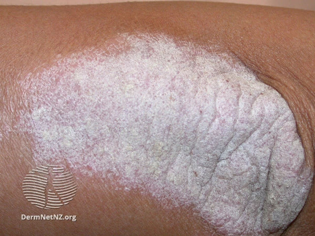 Types of Psoriasis: Pictures, Symptoms, and More | MyPsoriasisTeam