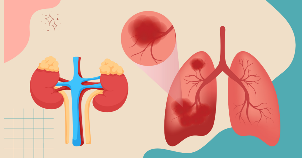 Lung Cancer Information MyLungCancerTeam