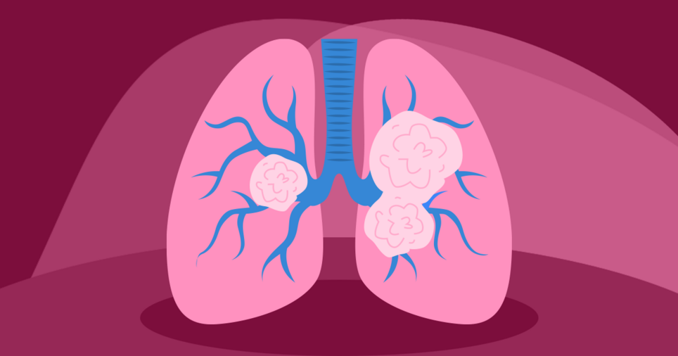 Lung Cancer Information MyLungCancerTeam