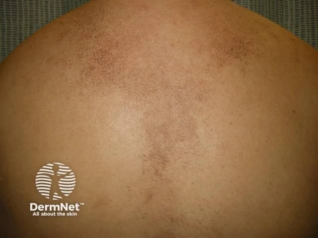 What Does Macular Amyloidosis Look Like Photos And Treatments What Does Macular Amyloidosis Look Like Photos And Treatments