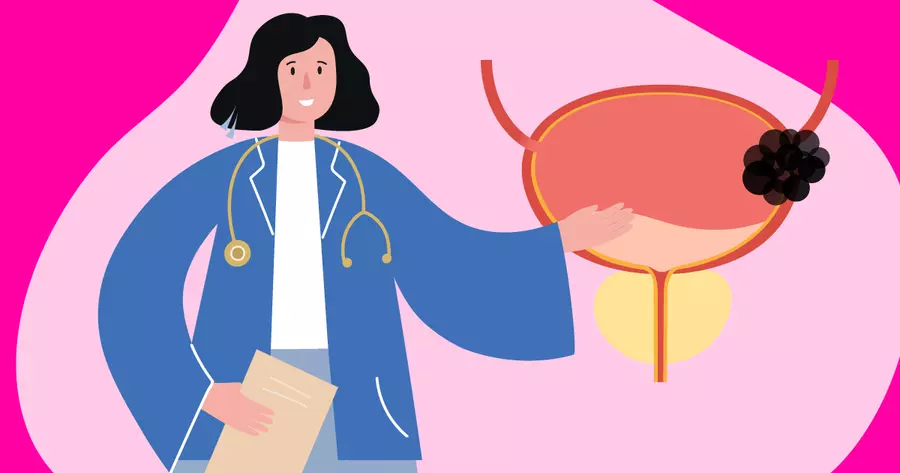 How Fast Does Bladder Cancer Spread? | MyBladderCancerTeam