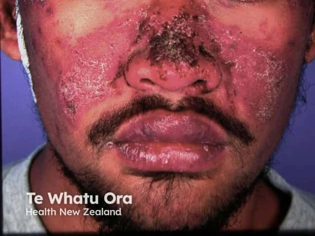 Rough, scaly rash across the cheeks and nose, forming a butterfly pattern typical of a severe malar rash associated with lupus.