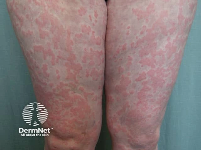 Red, blotchy patches cover the skin on both legs, indicating a widespread urticarial rash on light skin.