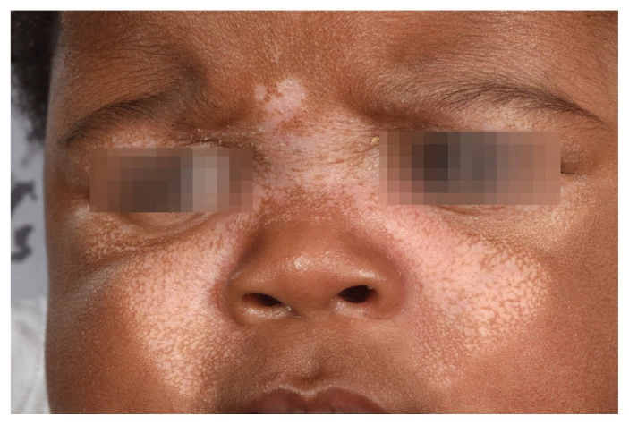 Symmetrical, pale patches with fine scale on the cheeks and nose of a child with dark skin — a classic butterfly-shaped rash seen in cutaneous lupus.