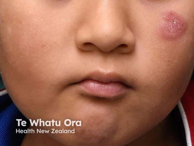 A well-defined, dark, scaly patch on the cheek, a common feature of discoid lupus erythematosus. 