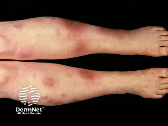 Multiple tender, red, raised nodules on both shins, consistent with erythema nodosum on light skin.