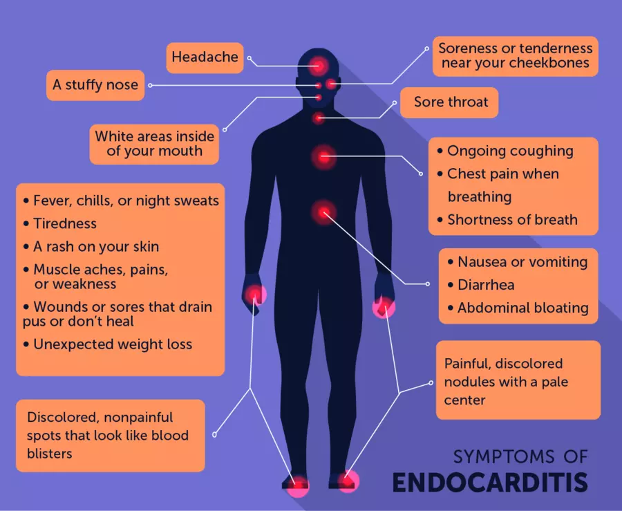 Diagram of a person showing endocarditis symptoms from head to toe, such as fever, rash, mouth sores, chest pain, cough, fatigue, discolored spots on the skin, and bumps on fingers or toes.