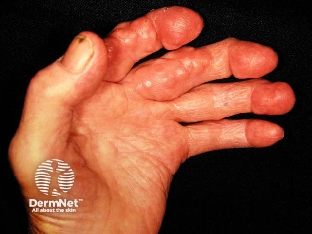 Multiple firm, rounded nodules over the finger joints on light skin, along with joint deformity and swelling, characteristic of rheumatoid nodules in rheumatoid arthritis.