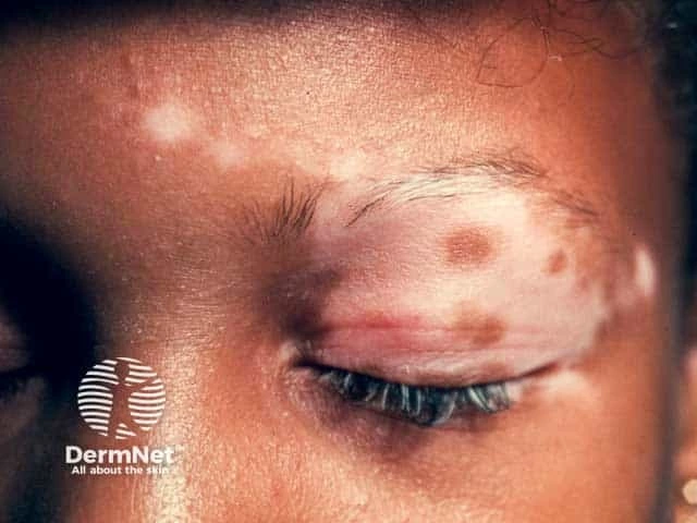 Close-up of a child’s face with dark skin and eyes closed. Pale patches around one eyebrow and eyelid, along with lighter hair in the eyebrow and eyelashes, show segmental vitiligo and loss of color.