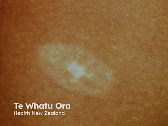Close-up of skin with trichrome vitiligo. A white patch is surrounded by a lighter ring of skin, creating a bull’s-eye pattern on otherwise darker skin.