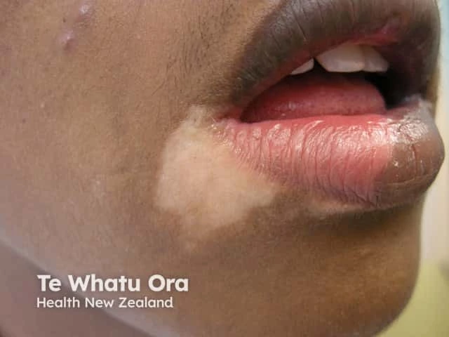Close-up of a person’s mouth with medium to dark skin showing a pale patch on the upper lip and nearby cheek, characteristic of vitiligo on dark skin.