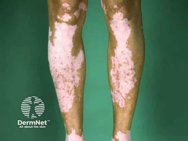 Legs with matching white patches on both sides, showing nonsegmental vitiligo. These light areas stand out from the person’s natural skin color, which is a little darker.