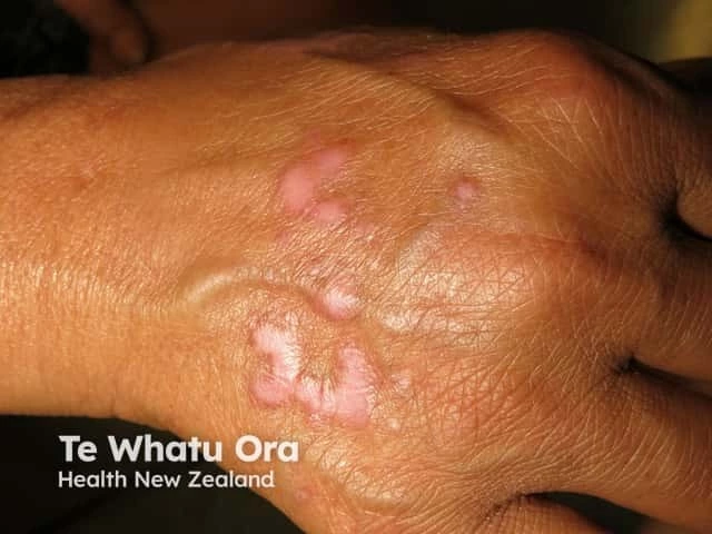 Irregular, light-colored patches with scars and thinning skin on the back of the hand in a person with medium brown skin. These are signs of discoid lupus. 