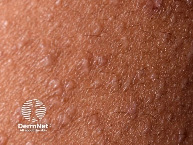 Numerous small, flesh-colored follicular papules with a rough texture, characteristic of follicular eczema on dark brown skin.