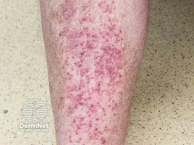 Numerous small, red, raised papules clustered on the lower leg, characteristic of papular eczema on light skin.
