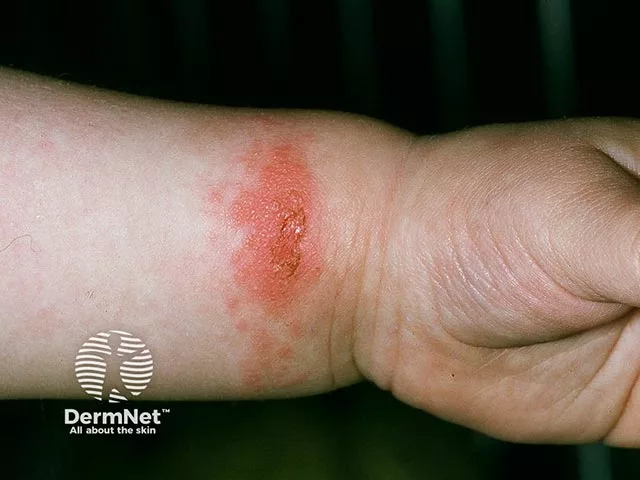 Red, scaly, and crusted patch with mild swelling on the wrist of a person with light skin, consistent with a nickel allergy.