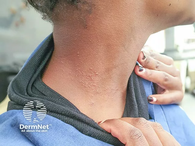 Small, raised, flesh-colored bumps on the side of the neck of a person with dark skin, consistent with allergic contact dermatitis from nickel exposure.