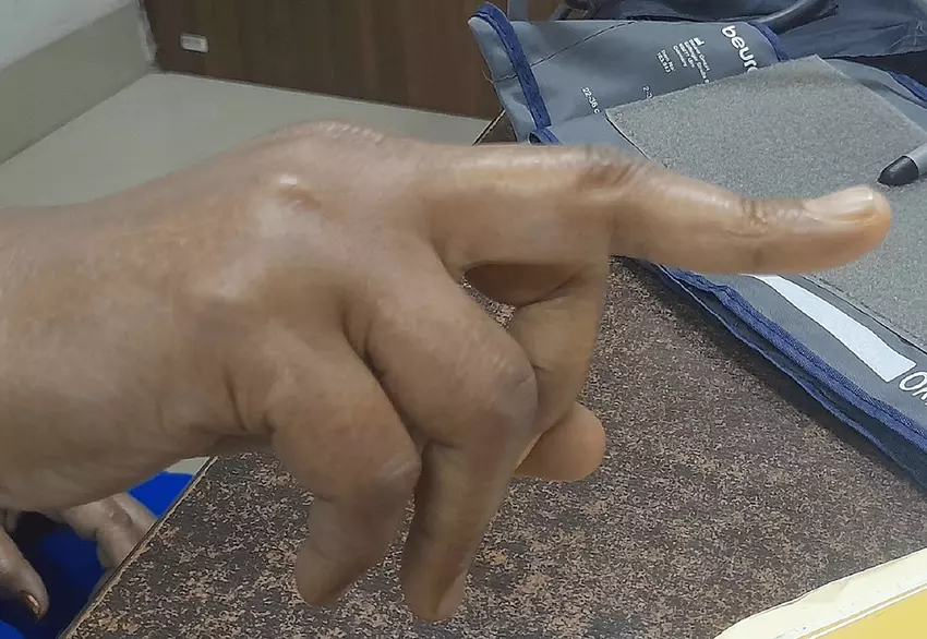A hand with boutonniere deformity with flexion at the middle joint of the index finger and hyperextension at the tip of the finger.