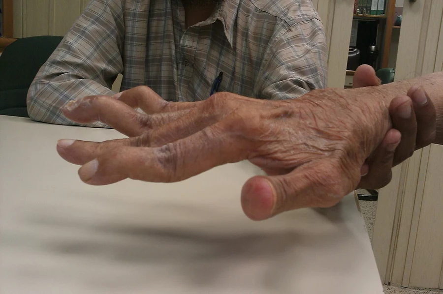 A hand with swan-neck deformity with hyperextension of the middle joints and flexion of the joint at the tip of the fingers.