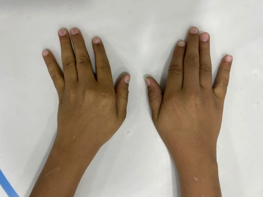Ulnar deviation of the fingers at the metacarpophalangeal joints.