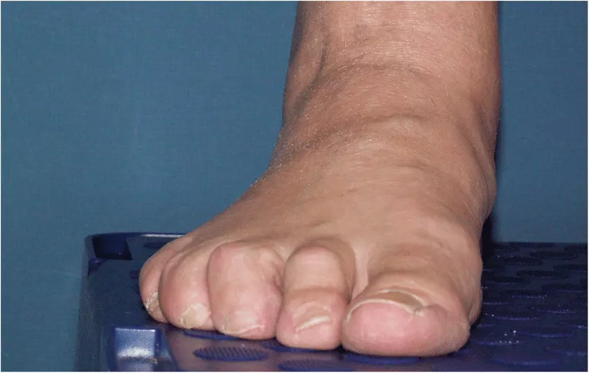 Claw toe deformity with hyperextension at the metatarsophalangeal joints and flexion at the proximal and distal interphalangeal joints of the toes.