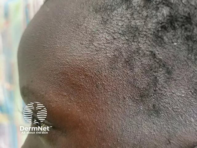 Mildly raised, rough, darkened patch on the forehead along the hairline, typical of allergic contact dermatitis.