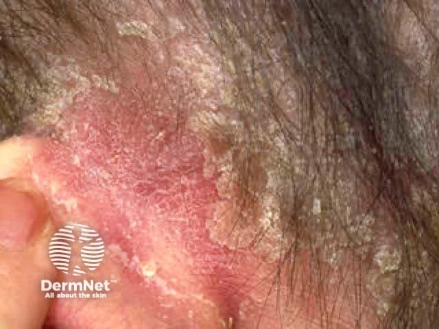 Red, inflamed skin with yellowish-white, greasy scales at the hairline and scalp, characteristic of sebopsoriasis on light skin.