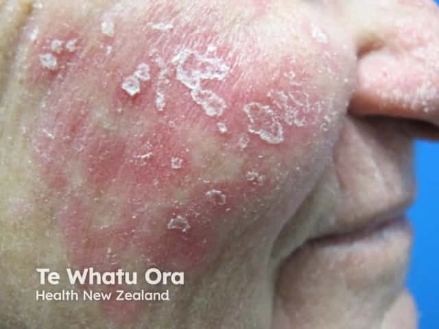 Red, inflamed cheek with well-defined, silvery-white scaling patches consistent with facial psoriasis on light skin.
