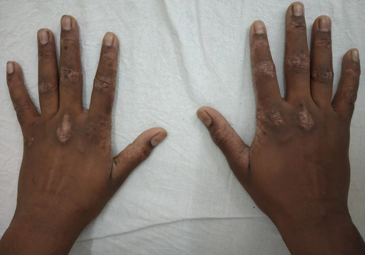 Thick, scaly plaques and patches of hypopigmentation and hyperpigmentation on the knuckles and fingers of a person with dark skin, consistent with psoriasis.