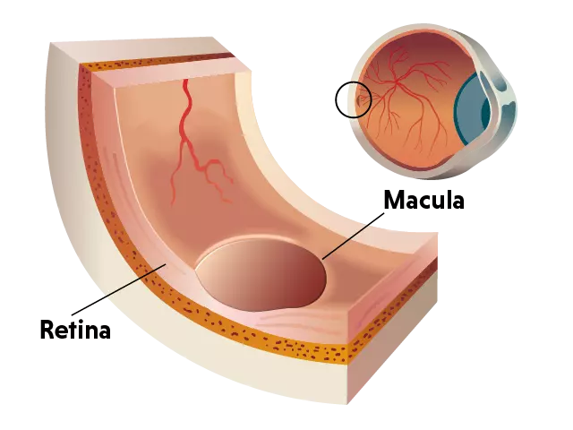 Cross-sectional diagram of the eye showing the retina as a thin layer lining the back of the eye and the macula as a small, central area within the retina responsible for sharp vision.