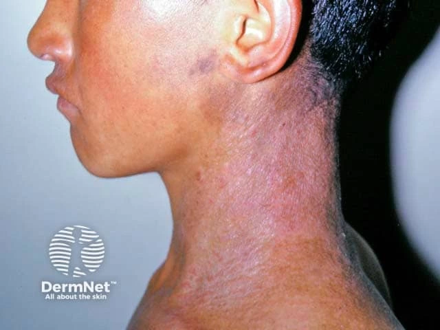 Ill-defined, scaly, thickened plaques with mild redness and hyperpigmentation on the neck of a person with medium-brown skin, consistent with atopic dermatitis (the most common type of eczema).