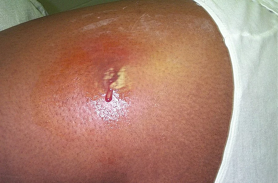 Painful, swollen abscess with central yellow pus and a droplet of blood on reddened skin of the thigh in a person with medium-brown skin, consistent with a Staphylococcus aureus infection.