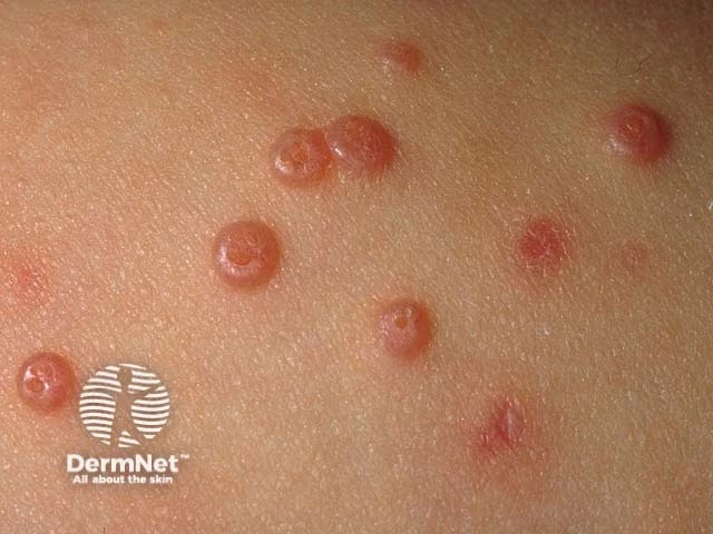 Multiple pink, dome-shaped, umbilicated papules clustered on light skin, characteristic of molluscum contagiosum.