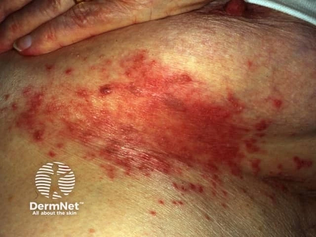Bright red, moist, scaly rash with satellite pustules under the breast on light skin, consistent with candidal intertrigo.