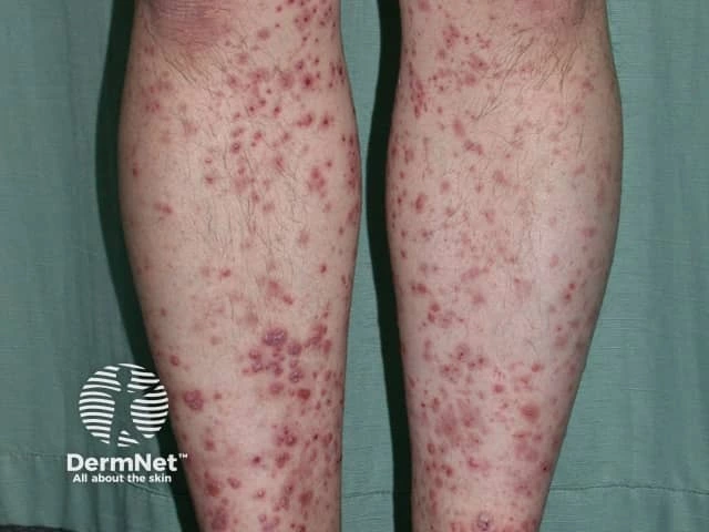 Numerous red-purple, nonblanching spots and plaques scattered on the lower legs of a person with light skin, characteristic of cutaneous vasculitis.