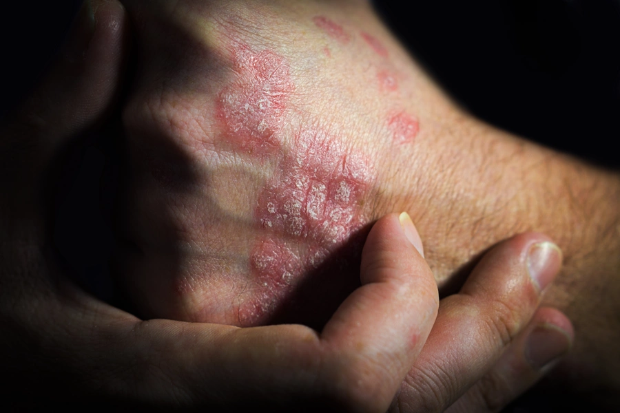 Red, scaly, and thickened plaques with silvery-white scaling on the back of the hand of a person with light skin, characteristic of psoriasis.