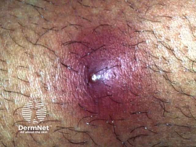 Painful, swollen, purplish boil with a central white pustule and surrounding inflammation on the hairy skin of a person with dark brown skin.