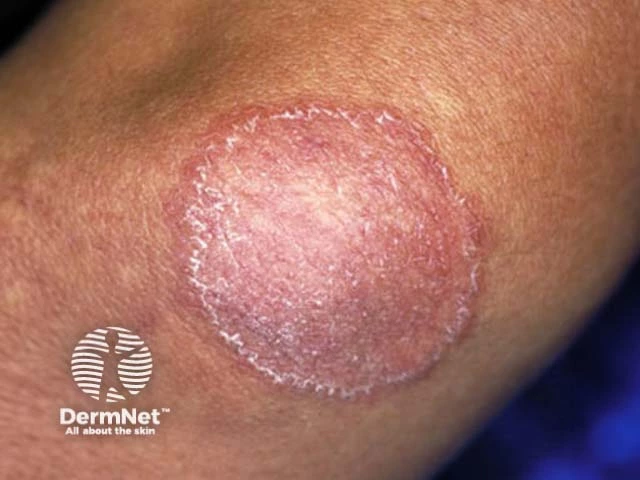 Round, scaly, pinkish plaque with a well-defined raised border on medium skin tone, characteristic of tinea corporis (ringworm).