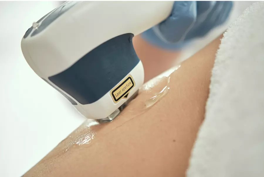 Laser hair removal device being applied to light skin with a clear gel, demonstrating the use of laser technology for hair reduction.