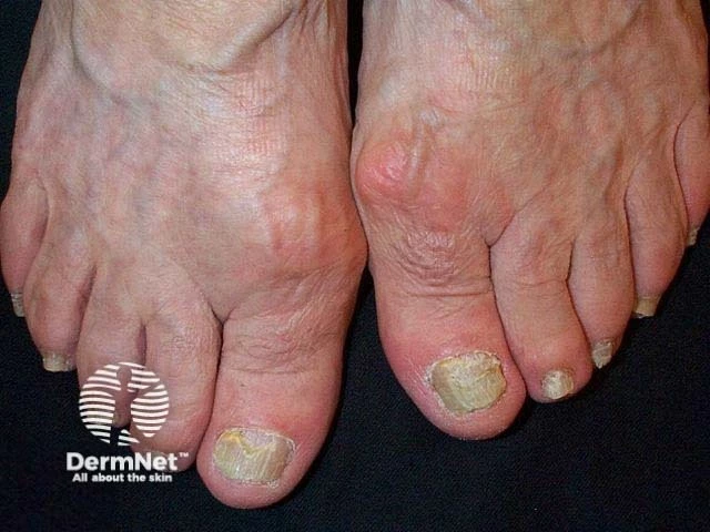 Thickened, yellow, and pitted toenails with irregular surface and onycholysis, consistent with nail psoriasis.