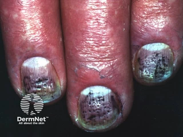 Multiple small depressions and irregular discoloration on the fingernails of a person with light skin, characteristic of nail pitting often seen in psoriasis.