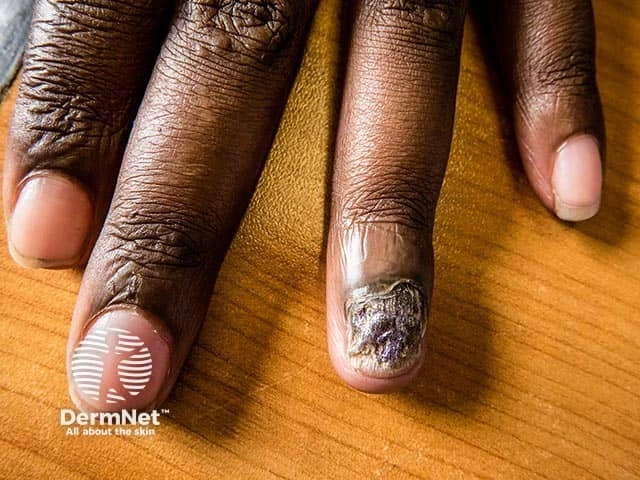 Thickened, discolored, and brittle nail with debris and onycholysis on the middle finger of a person with dark brown skin, characteristic of onychomycosis (fungal nail infection).