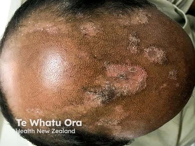 Thick, scaly, silvery-white plaques with areas of redness and flaking on the scalp of a person with dark brown skin, consistent with scalp psoriasis.